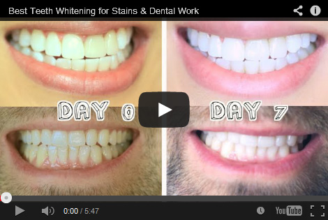 maat insect rol Teeth Whitening Reviews - Best As Of September 2021 - Smile Brilliant